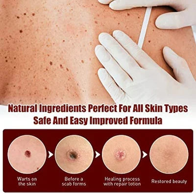 Skin Tag Mole Remover Pen With Tea Tree Oil Fast Household