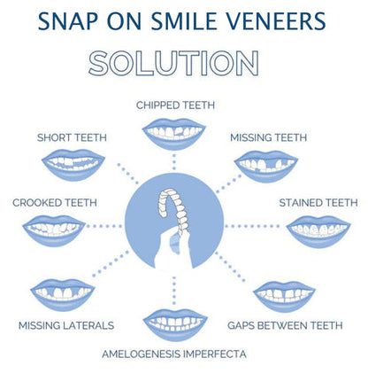Veneers Smile Upper And Lower Instant Cover For All Day